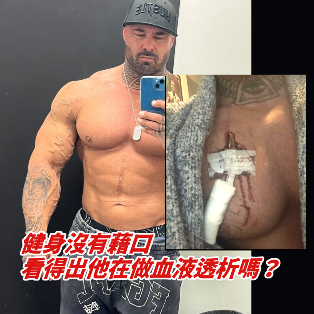 Frank McGrath 天生只有一顆腎，即使如此也堅持訓練