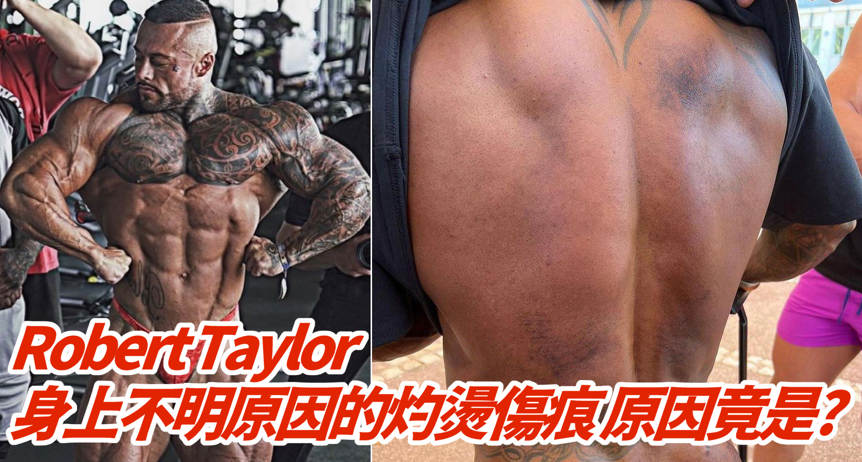 IFBB Pro Robert Taylor 身上不明原因的燒燙傷是怎麼回事？